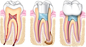  endodontinis dantu kanalu gydymas