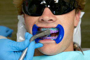  Laser teeth whitening 
